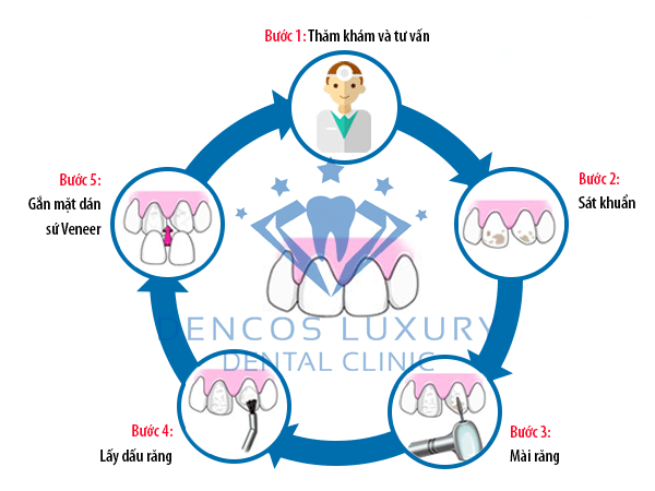 Hình ảnh mô tả quy trình dịch vụ mặt dán sứ Veneer tại Nha khoa Dencos Luxury mat-dan-su-2