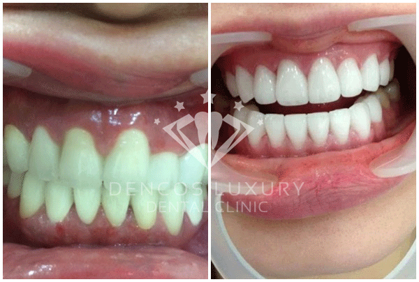 Hiệu quả tùy cơ địa mỗi người mat-dan-su-veneer