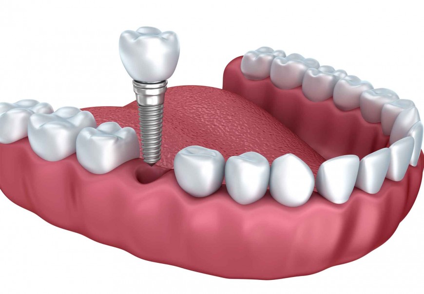 Phục hình răng sứ kết hợp Imlant cho trường hợp mất răng phuc-hinh-rang-su1