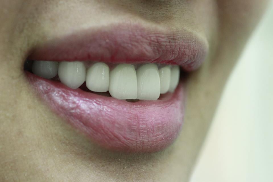 Chỉ định thực hiện dịch vụ tạo hình răng thỏ Hàn Quốc tao-hinh-rang-tho2