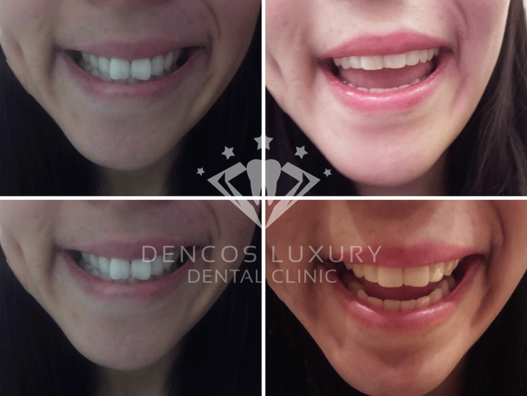 Trước - sau tạo hình răng thỏ tại Dencos Luxury tao-hinh-rang-tho4