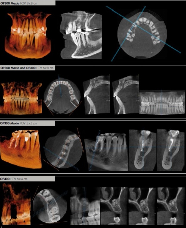 cắm răng implant