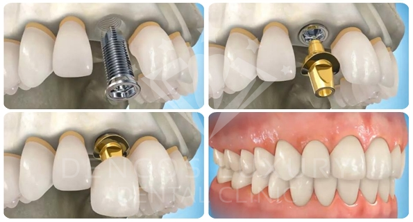 Cấy ghép răng Implant 7