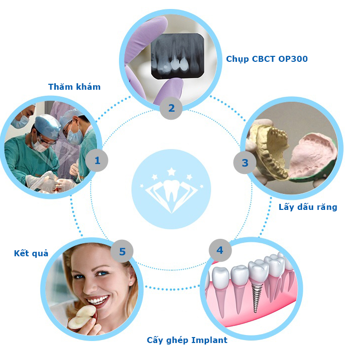 Quy trình cấy ghép răng implant Cấy ghép răng Implant 8