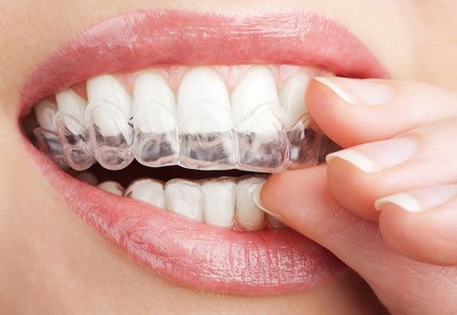 Niềng răng Invisalign bao nhiêu tiền