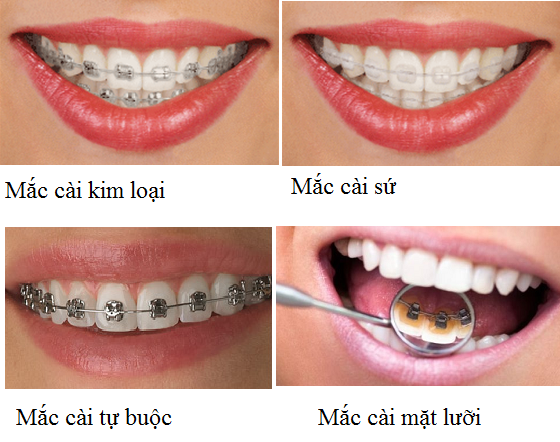 Niềng răng mắc cài 3