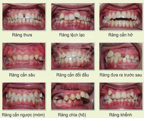 Niềng răng mắc cài 2