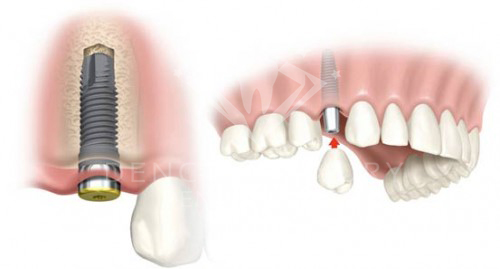 Trồng răng Implant có đau không 2