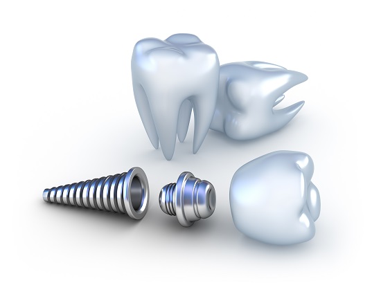 cắm răng implant